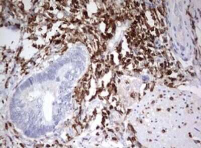 Immunohistochemistry: DOCK2 Antibody (7G2) [NBP2-46468] - Analysis of Adenocarcinoma of Human colon tissue. (Heat-induced epitope retrieval by 10mM citric buffer, pH6.0, 120C for 3min)