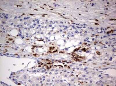 Immunohistochemistry: DOCK2 Antibody (7G2) [NBP2-46468] - Analysis of Carcinoma of Human liver tissue.