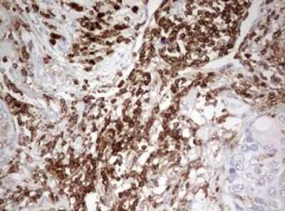 Immunohistochemistry: DOCK2 Antibody (7G2) [NBP2-46468] - Analysis of Carcinoma of Human lung tissue.(Heat-induced epitope retrieval by 10mM citric buffer, pH6.0, 120C for 3min)