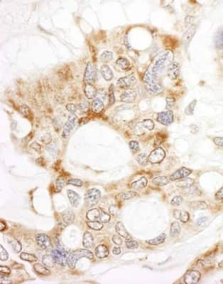 <b>Independent Antibodies Validation and Biological Strategies Validation.</b>Immunohistochemistry-Paraffin: DOCK4 Antibody [NBP1-26648] - Human ovarian carcinoma. Antibody used at a dilution of 1:200 (1ug/ml).