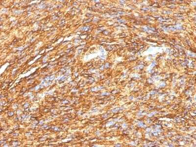 Immunohistochemistry-Paraffin: DOG1/TMEM16A Antibody (DG1/1484) - Azide and BSA Free [NBP2-54492] - Formalin-fixed, paraffin-embedded human GIST stained with DOG-1 Monoclonal Antibody (DG1/1484).