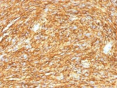 Immunohistochemistry-Paraffin: DOG1/TMEM16A Antibody (DG1/1485) - Azide and BSA Free [NBP2-54485] - Formalin-fixed, paraffin-embedded human GIST stained with DOG-1 Monoclonal Antibody (DG1/1485).