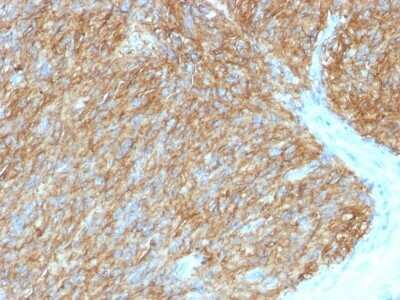 Immunohistochemistry-Paraffin: DOG1/TMEM16A Antibody (DG1/1486) - Azide and BSA Free [NBP2-54484] - Formalin-fixed, paraffin-embedded human GIST stained with DOG-1 Monoclonal Antibody (DG1/1486).