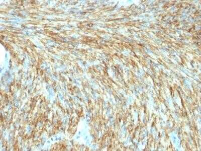 Immunohistochemistry-Paraffin: DOG1/TMEM16A Antibody (DG1/1487R) - Azide and BSA Free [NBP2-54326] - Formalin-fixed, paraffin-embedded human GIST stained with DOG-1 Rabbit Recombinant Monoclonal Antibody (DG1/1487R).