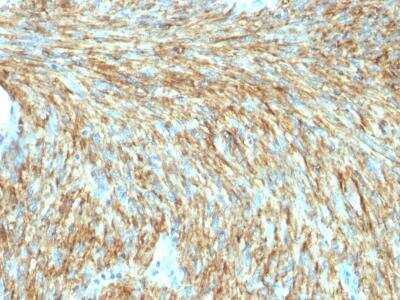 Immunohistochemistry-Paraffin: DOG1/TMEM16A Antibody (DG1/1487R) [NBP2-53137] - Formalin-fixed, paraffin-embedded human GIST stained with DOG-1 Rabbit Recombinant Monoclonal Antibody (DG1/1487R).