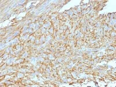 Immunohistochemistry-Paraffin: DOG1/TMEM16A Antibody (DG1/447 + DOG-1.1) - Azide and BSA Free [NBP2-34604] - Formalin-fixed, paraffin-embedded human GIST stained with DOG1 Monoclonal Antibody (DG1/447+ DOG1.1)