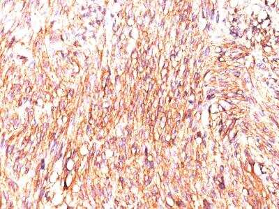 Immunohistochemistry-Paraffin: DOG1/TMEM16A Antibody (DOG-1.1) - IHC-Prediluted [NBP2-48151] - GIST stained with DOG-1 Mouse Monoclonal Antibody (DOG1.1).