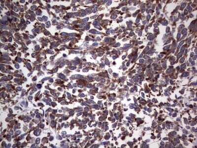 Immunohistochemistry: DOG1/TMEM16A Antibody (OTI1C8) - Azide and BSA Free [NBP2-71987] - Analysis of Human melanoma tissue. (Heat-induced epitope retrieval by 1 mM EDTA in 10mM Tris, pH8.5, 120C for 3min)