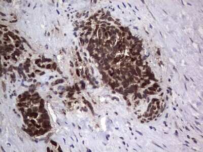 Immunohistochemistry: DOG1/TMEM16A Antibody (OTI1C8) - Azide and BSA Free [NBP2-71987] - Analysis of Human testicular cancer tissue.(Heat-induced epitope retrieval by 1 mM EDTA in 10mM Tris, pH8.5, 120C for 3min)