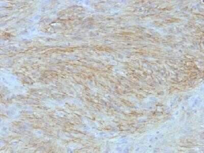 Immunohistochemistry-Paraffin: DOG1/TMEM16A Antibody (SPM580) - Azide and BSA Free [NBP2-34812] - Formalin-fixed paraffin-embedded human GIST stained with DOG1 Monoclonal Antibody (SPM580).