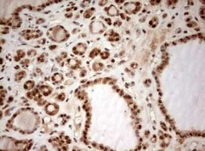 Immunohistochemistry: DOT1L Antibody (OTI6E7) - Azide and BSA Free [NBP2-72298] - Analysis of Carcinoma of Human thyroid tissue. (Heat-induced epitope retrieval by 10mM citric buffer, pH6.0, 120C for 3min)