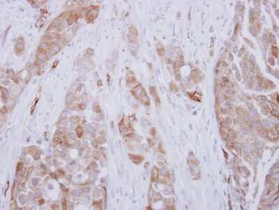 Immunohistochemistry-Paraffin: DPH2 Antibody [NBP2-16218] - Immunohistochemical analysis of paraffin-embedded Breast carcinoma, using antibody at 1:500 dilution.