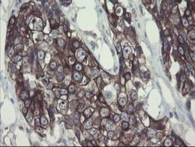 Immunohistochemistry: DPH2 Antibody (OTI3A12) - Azide and BSA Free [NBP2-70587] - Analysis of Adenocarcinoma of Human breast tissue.