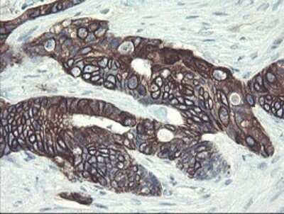 Immunohistochemistry: DPH2 Antibody (OTI3A12) - Azide and BSA Free [NBP2-70587] - Analysis of Adenocarcinoma of Human colon tissue.