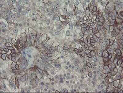 Immunohistochemistry: DPH2 Antibody (OTI3A12) - Azide and BSA Free [NBP2-70587] - Analysis of Adenocarcinoma of Human ovary tissue.