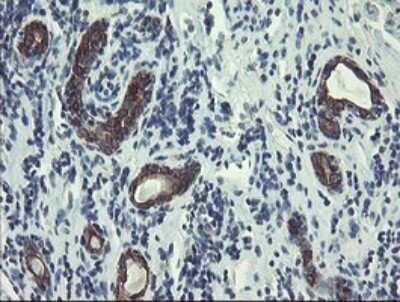 Immunohistochemistry: DPH2 Antibody (OTI3A12) - Azide and BSA Free [NBP2-70587] - Analysis of Carcinoma of Human kidney tissue.