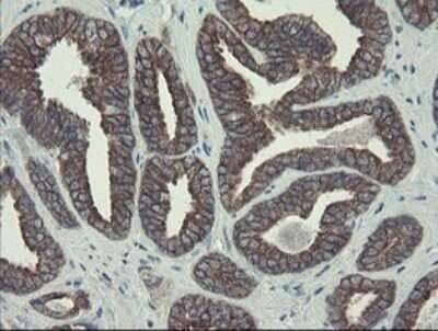 Immunohistochemistry: DPH2 Antibody (OTI3A12) - Azide and BSA Free [NBP2-70587] - Analysis of Carcinoma of Human prostate tissue.