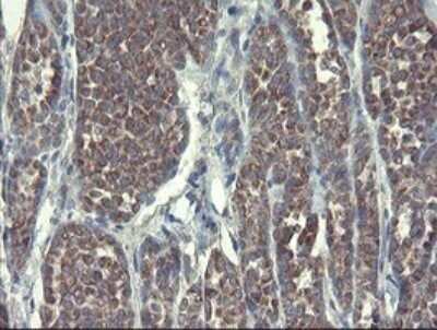 Immunohistochemistry: DPH2 Antibody (OTI3A12) - Azide and BSA Free [NBP2-70587] - Analysis of Carcinoma of Human thyroid tissue.