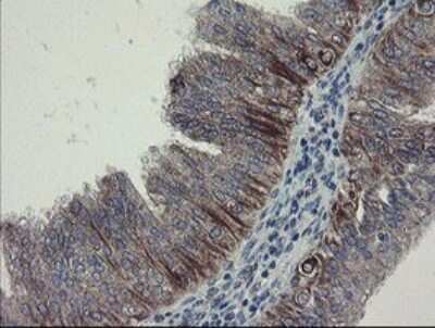 Immunohistochemistry: DPH2 Antibody (OTI3A12) [NBP2-46475] - Analysis of Adenocarcinoma of Human endometrium tissue.