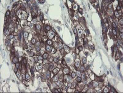 Immunohistochemistry: DPH2 Antibody (OTI3A12) [NBP2-46475] - Analysis of Adenocarcinoma of Human breast tissue.