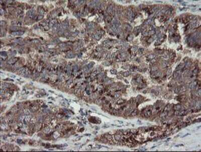 Immunohistochemistry: DPH2 Antibody (OTI4E7) - Azide and BSA Free [NBP2-70585] - Staining of paraffin-embedded Adenocarcinoma of Human ovary tissue using anti-DPH2 mouse monoclonal antibody.