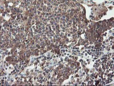 Immunohistochemistry: DPH2 Antibody (OTI4E7) - Azide and BSA Free [NBP2-70585] - Staining of paraffin-embedded Carcinoma of Human bladder tissue using anti-DPH2 mouse monoclonal antibody.