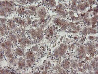Immunohistochemistry: DPH2 Antibody (OTI4E7) - Azide and BSA Free [NBP2-70585] - Staining of paraffin-embedded Carcinoma of Human liver tissue using anti-DPH2 mouse monoclonal antibody.