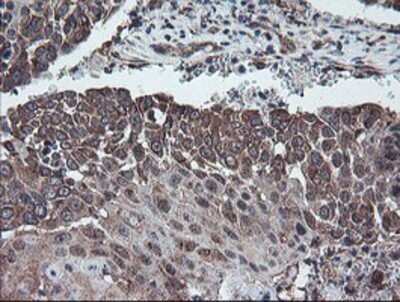 Immunohistochemistry: DPH2 Antibody (OTI4E7) - Azide and BSA Free [NBP2-70585] - Staining of paraffin-embedded Carcinoma of Human lung tissue using anti-DPH2 mouse monoclonal antibody.