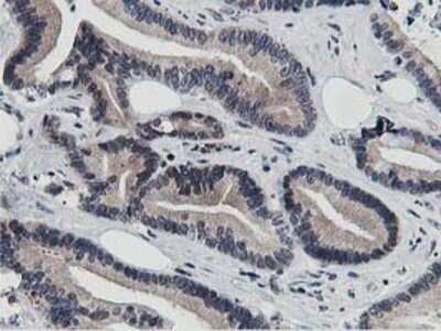 Immunohistochemistry: DPP3 Antibody (OTI2D9) - Azide and BSA Free [NBP2-71541] - Staining of paraffin-embedded Adenocarcinoma of Human colon tissue using anti-DPP3 mouse monoclonal antibody.