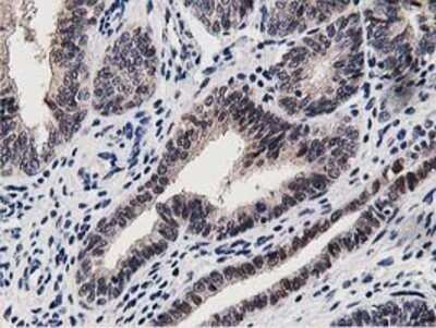 Immunohistochemistry: DPP3 Antibody (OTI2D9) - Azide and BSA Free [NBP2-71541] - Staining of paraffin-embedded Adenocarcinoma of Human endometrium tissue using anti-DPP3 mouse monoclonal antibody.