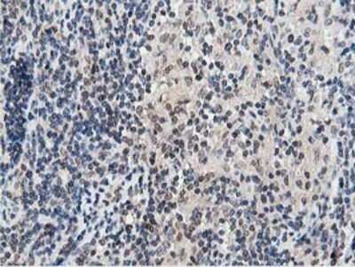 Immunohistochemistry: DPP3 Antibody (OTI2D9) - Azide and BSA Free [NBP2-71541] - Staining of paraffin-embedded Human lymphoma tissue using anti-DPP3 mouse monoclonal antibody.