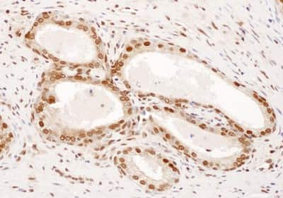 Immunohistochemistry-Paraffin: DPY30 Antibody [NBP2-32201] - Sample: FFPE section of human prostate carcinoma. Antibody: Affinity purified rabbit anti- DPY30 used at a dilution of 1:1,000 (1ug/ml). Detection: DAB. Counterstain: IHC Hematoxylin (blue).