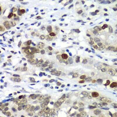 Immunohistochemistry-Paraffin: DR1 Antibody [NBP2-92857] - Paraffin-embedded human gastric cancer using DR1 .