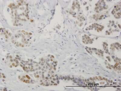 Immunohistochemistry-Paraffin: DRAK1 Antibody (4D12) [H00009263-M03] - Analysis of monoclonal antibody to STK17A on formalin-fixed paraffin-embedded human colon cancer. Antibody concentration 1.2 ug/ml