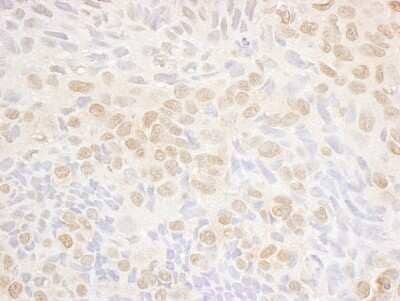 <b>Independent Antibodies Validation and Biological Strategies Validation.</b>Immunohistochemistry-Paraffin: DRAK1 Antibody [NBP1-42693] - Sample: FFPE section of human lung carcinoma. Antibody: Affinity purified rabbit anti- DRAK1 used at a dilution of 1:200 (1ug/ml). Detection: DAB