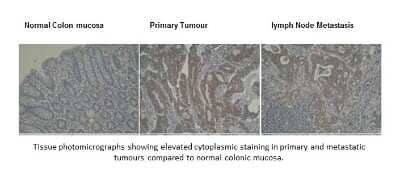 Immunohistochemistry: DRAM Antibody (M3-P4B4) [NBP2-50379] - Analysis of normal colon mucosa, primary tumour and lymph node metastasis sections.