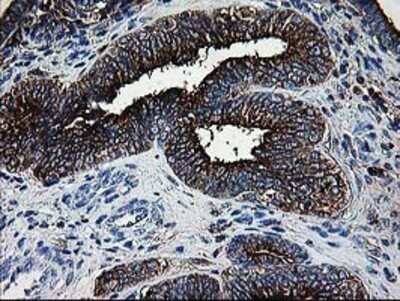 Immunohistochemistry: DTYMK Antibody (OTI1G8) - Azide and BSA Free [NBP2-70604] - Staining of paraffin-embedded Adenocarcinoma of Human endometrium tissue using anti-DTYMK mouse monoclonal antibody.