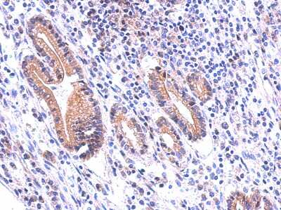 Immunohistochemistry-Paraffin: DUOX1 Antibody [NBP2-16232] - Human gastric cancer, using DUOX1 antibody at 1:500 dilution. Antigen Retrieval: Trilogy™ (EDTA based, pH 8.0) buffer, 15min