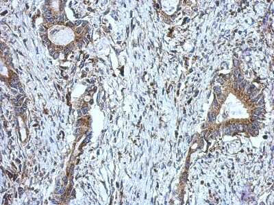 Immunohistochemistry-Paraffin: DUS2L Antibody [NBP2-16233] - Immunohistochemical analysis of paraffin-embedded Colon ca, using antibody at 1:500 dilution.