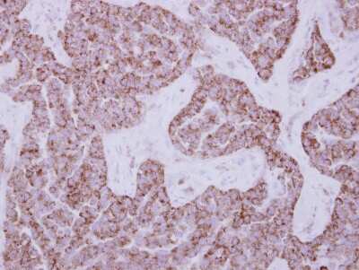 Immunohistochemistry-Paraffin: DUS2L Antibody [NBP2-16234] - Immunohistochemical analysis of paraffin-embedded Lung ca, using antibody at 1:500 dilution.