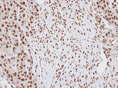 Immunohistochemistry-Paraffin: DUSP2 Antibody [NBP2-14934] - Paraffin-embedded Oral CA, using antibody at 1:100 dilution.