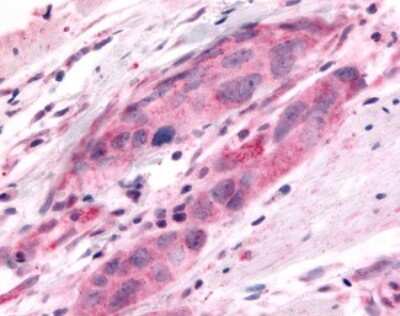 Immunohistochemistry-Paraffin: DUSP22 Antibody [NLS6811] - Analysis of anti-DUSP22 / JSP 1 antibody with human colon, carcinoma.