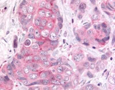 Immunohistochemistry-Paraffin: DUSP22 Antibody [NLS7972] - Analysis of anti-DUSP22 / JSP 1 antibody with human colon, carcinoma.