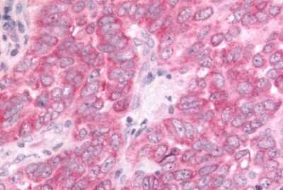 Immunohistochemistry-Paraffin: DUSP22 Antibody [NLS7972] - Anti-DUSP22 / JSP 1 antibody IHC of human Lung, Non-Small Cell Carcinoma. Immunohistochemistry of formalin-fixed, paraffin-embedded tissue after heat-induced antigen retrieval.