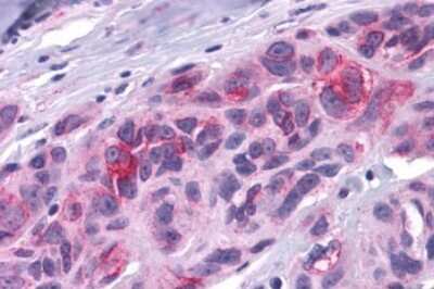 Immunohistochemistry-Paraffin: DUSP23 Antibody [NLS6803] - Anti-DUSP23 antibody IHC of human Skin, Melanoma. Immunohistochemistry of formalin-fixed, paraffin-embedded tissue after heat-induced antigen retrieval.