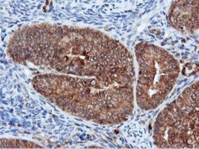 Immunohistochemistry: DUSP23 Antibody (OTI3C10) - Azide and BSA Free [NBP2-71976] - Staining of paraffin-embedded Adenocarcinoma of Human endometrium tissue using anti-DUSP23 mouse monoclonal antibody.