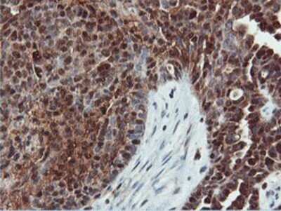 Immunohistochemistry: DUSP23 Antibody (OTI3C10) - Azide and BSA Free [NBP2-71976] - Staining of paraffin-embedded Adenocarcinoma of Human ovary tissue using anti-DUSP23 mouse monoclonal antibody.