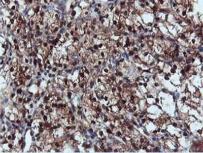 Immunohistochemistry: DUSP23 Antibody (OTI3C10) - Azide and BSA Free [NBP2-71976] - Staining of paraffin-embedded Carcinoma of Human kidney tissue using anti-DUSP23 mouse monoclonal antibody.