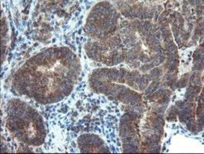 Immunohistochemistry: DUSP27/DUPD1 Antibody (OTI7E4) - Azide and BSA Free [NBP2-72503] - DUSP27/DUPD1 Antibody (7E4) Staining of paraffin-embedded Adenocarcinoma of Human endometrium tissue using anti-DUSP27 mouse monoclonal antibody.
