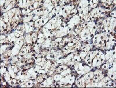 Immunohistochemistry: DUSP27/DUPD1 Antibody (OTI7E4) - Azide and BSA Free [NBP2-72503] - DUSP27/DUPD1 Antibody (7E4) Staining of paraffin-embedded Carcinoma of Human kidney tissue using anti-DUSP27 mouse monoclonal antibody.